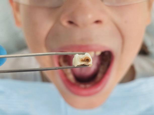 Best Emergency Treatment for Oral Infections in Shepherd, TX