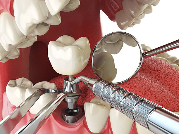 Best Broken or Chipped Tooth Repair in Shepherd, TX